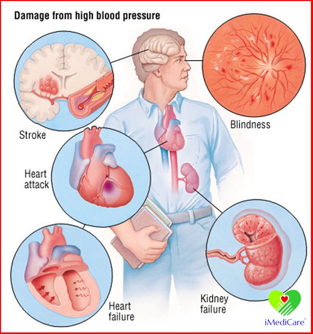 Mức độ nguy hiểm của bệnh cao huyết áp