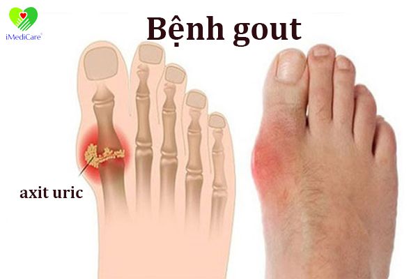 benh-gout