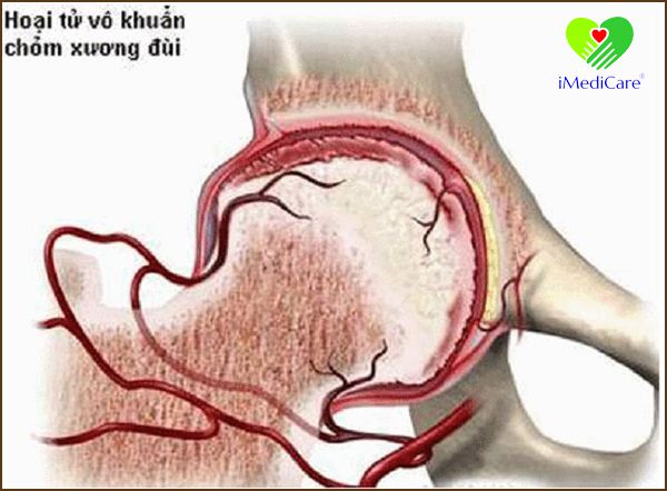 benh hoai tu vo khuan chom xuong dui