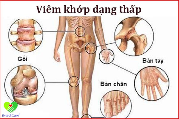 viem-khop-dang-thap