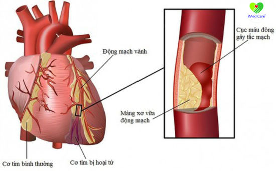 Bí quyết ứng phó với bệnh nhồi máu cơ tim hiệu quả