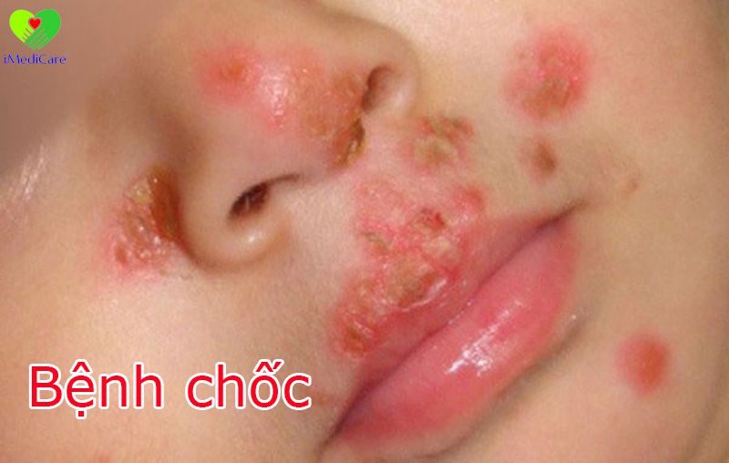 benh choc