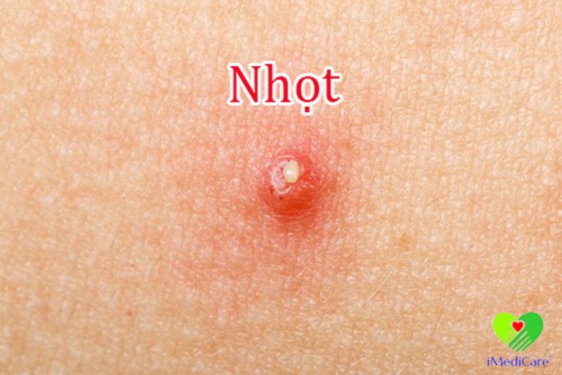 nhot