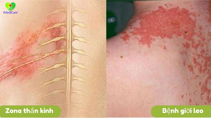 benh-viem-da-tiep-xuc-do-con-trung1