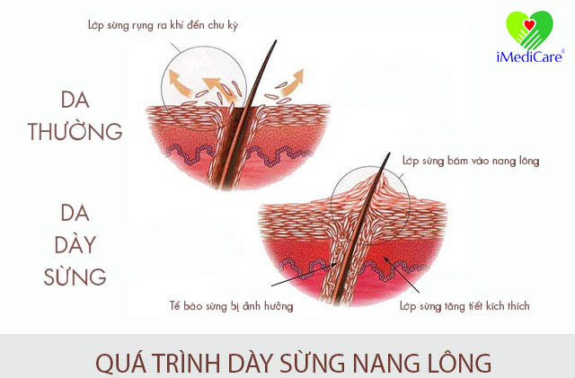 benh-day-sung-nang-long1