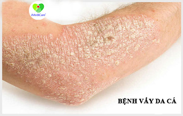 benh-vay-da-ca