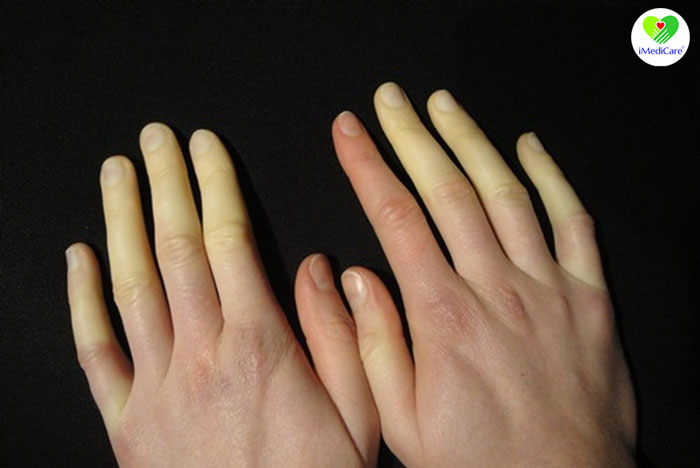 hoi-chung-raynaud