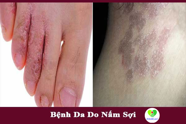 benh-da-do-nam-soi