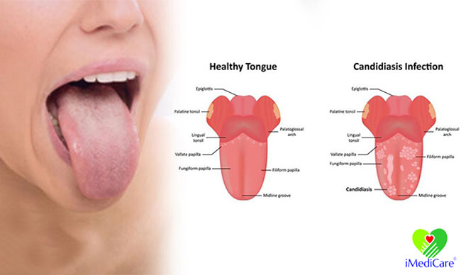nhiem-nam-candida-la-benh-gi
